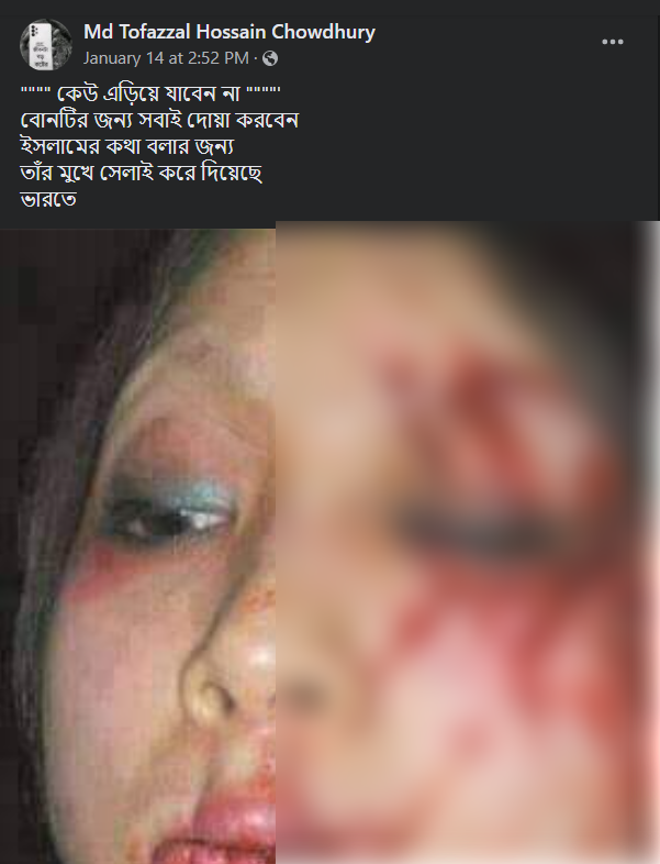 তরুণীর মুখ চোখ সেলাই করা image 2