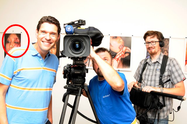 তরুণীর মুখ চোখ সেলাই করা image 4