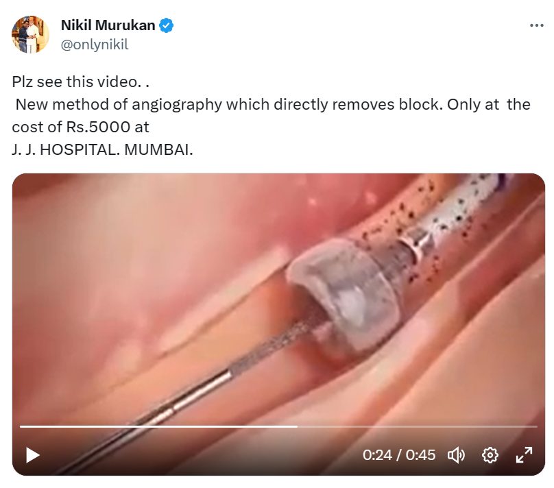 Fact Check: जे. जे. हॉस्पिटलमध्ये नवीन अँजिओग्राफी पद्धत फक्त ₹5000 मध्ये? खोटा आहे हा दावा