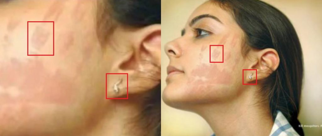 Fact Check: कंगना राणावतच्या गालावर उमटलेली थप्पडेची खूण असल्याचे सांगत व्हायरल झालेल्या फोटोचे सत्य जाणून घ्या